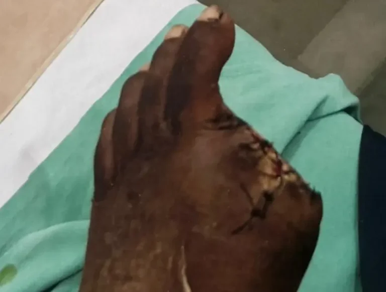 नाली सफाईच्या कामात बालमजूर जखमी; कायमस्वरूपी अपंगत्व आल्याचा आरोप लाखणी  तालुक्यातील कवडसी येथील प्रकार